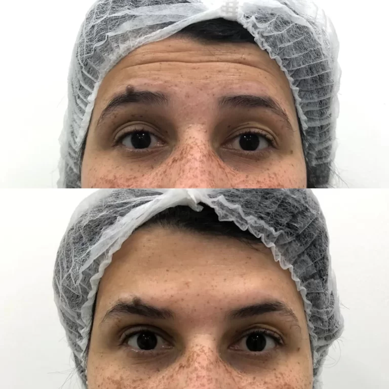 botox paciente 1 (1)