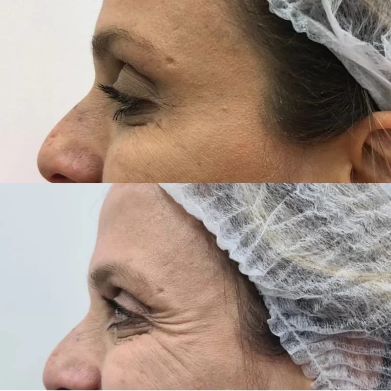 botox paciente 3 (1)